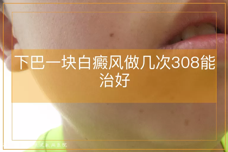 下巴一块白癜风做几次308能治好