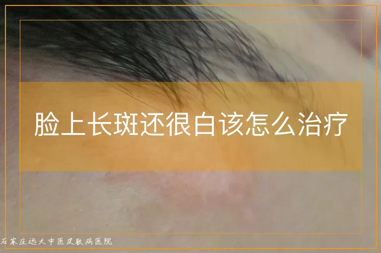 脸上长斑还很白该怎么治疗