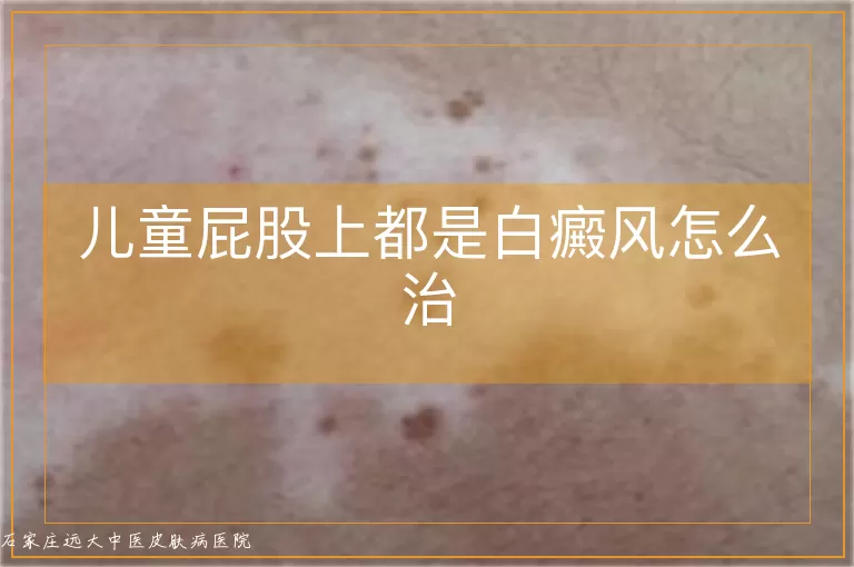 儿童屁股上都是白癜风怎么治