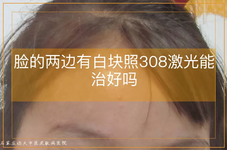 脸的两边有白块照308激光能治好吗
