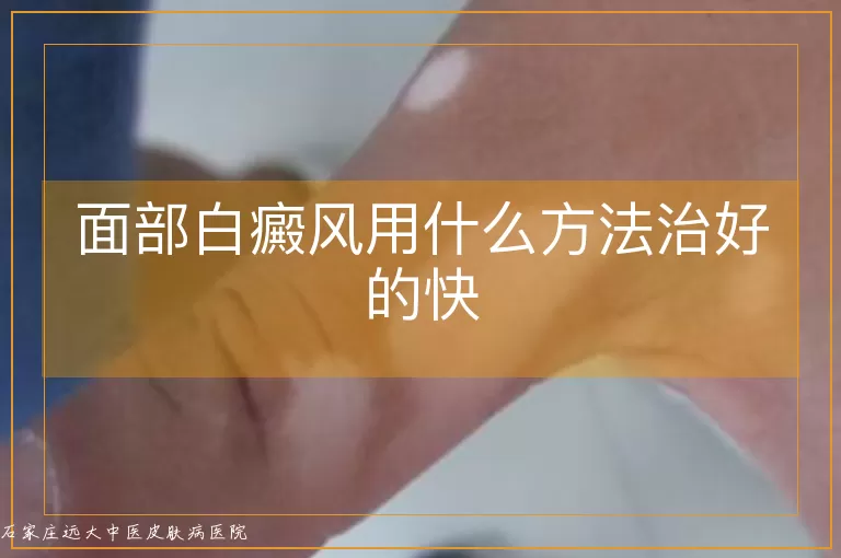 面部白癜风用什么方法治好的快