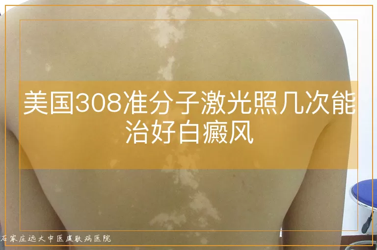 美国308准分子激光照几次能治好白癜风