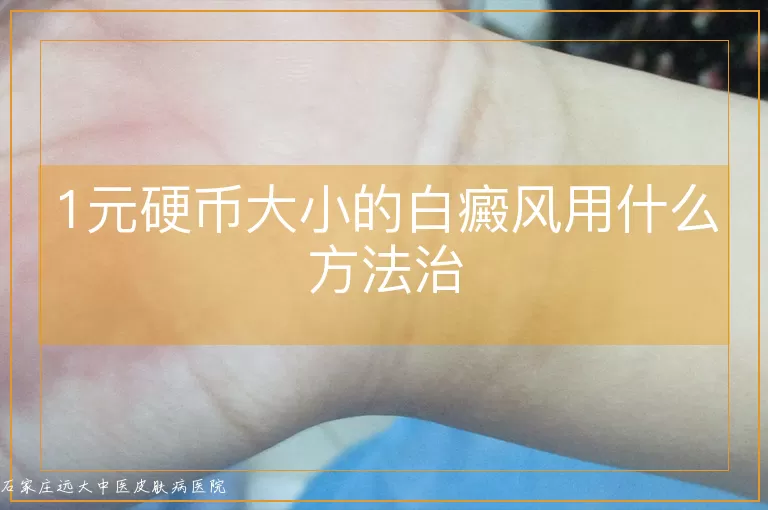 1元硬币大小的白癜风用什么方法治