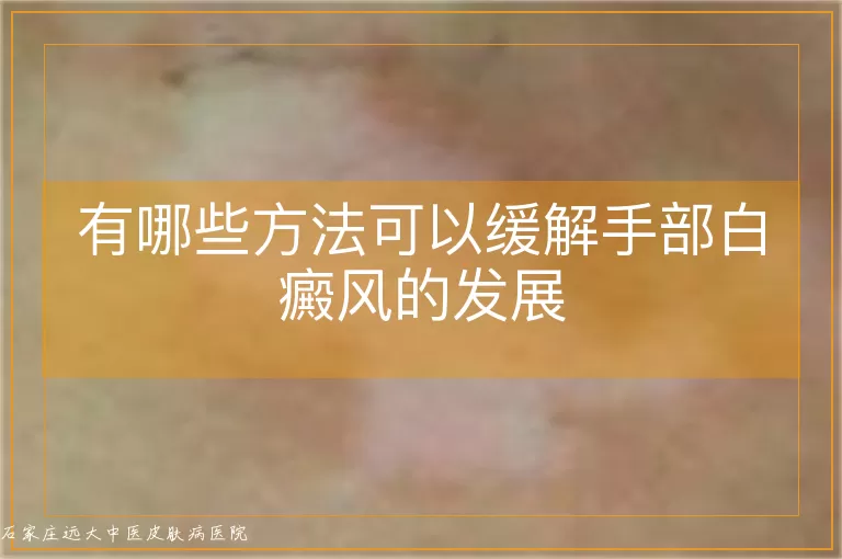 有哪些方法可以缓解手部白癜风的发展