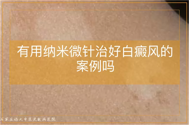 有用纳米微针治好白癜风的案例吗