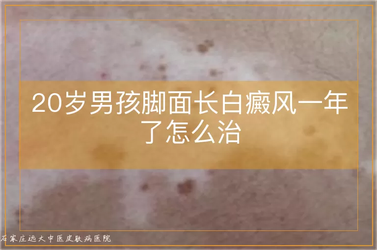 20岁男孩脚面长白癜风一年了怎么治