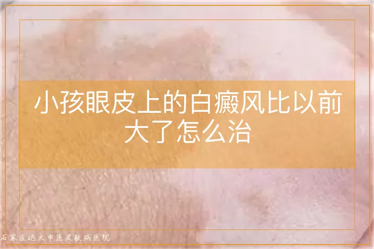 小孩眼皮上的白癜风比以前大了怎么治