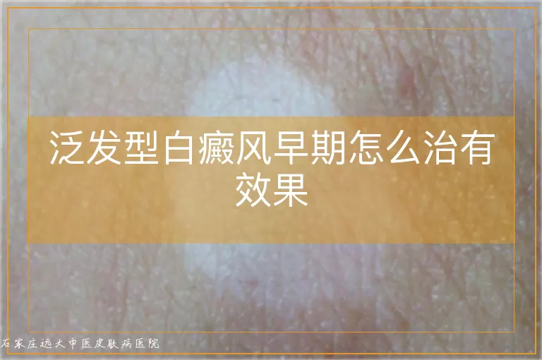 泛发型白癜风早期怎么治有效果