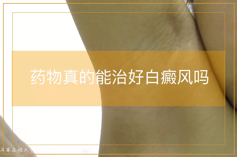药物真的能治好白癜风吗