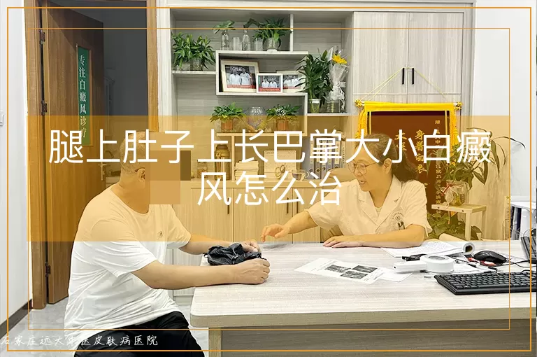 腿上肚子上长巴掌大小白癜风怎么治