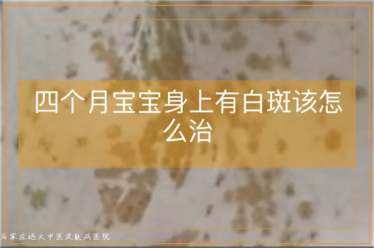 四个月宝宝身上有白斑该怎么治