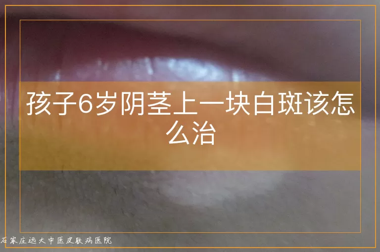 孩子6岁阴茎上一块白斑该怎么治