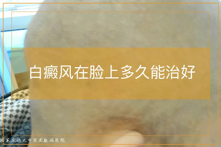 白癜风在脸上多久能治好