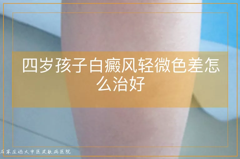 四岁孩子白癜风轻微色差怎么治好