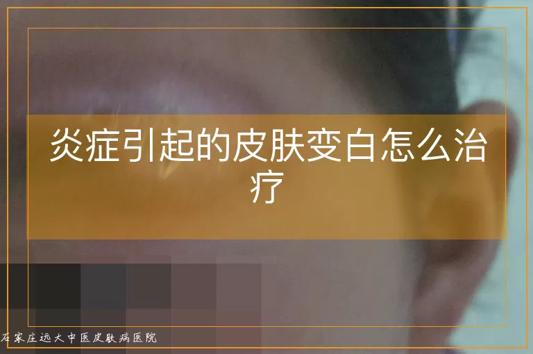 炎症引起的皮肤变白怎么治疗