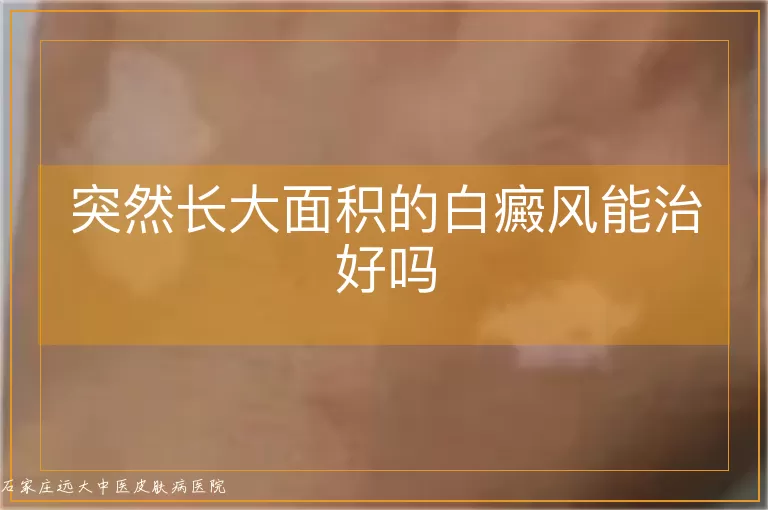 突然长大面积的白癜风能治好吗