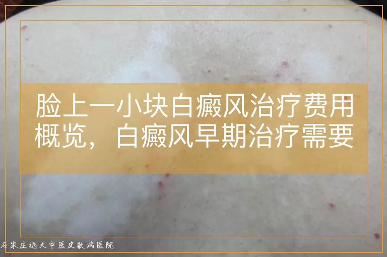 脸上一小块白癜风治疗费用概览，白癜风早期治疗需要多少钱，面部白斑单次治疗大概预算