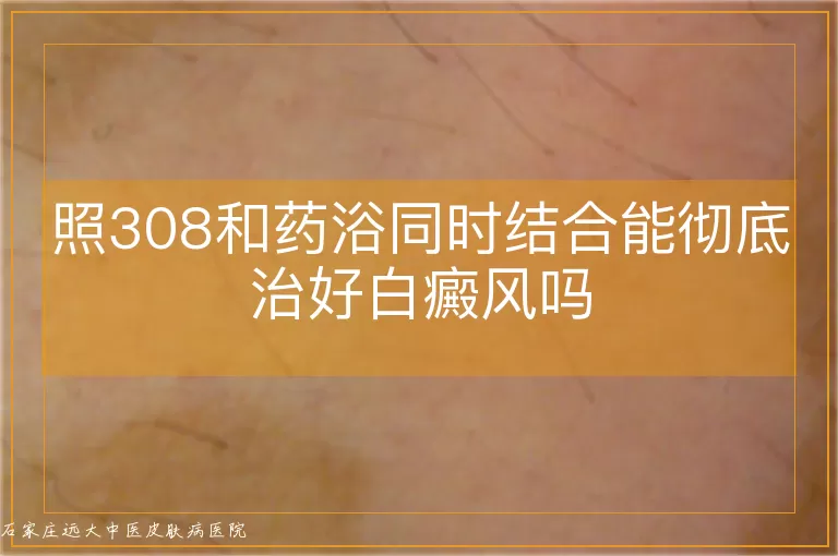 照308和药浴同时结合能彻底治好白癜风吗