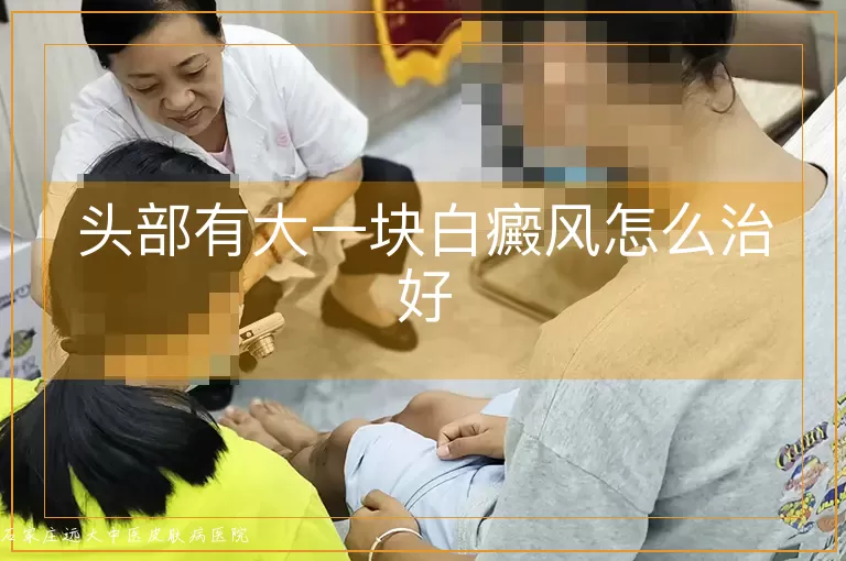 头部有大一块白癜风怎么治好
