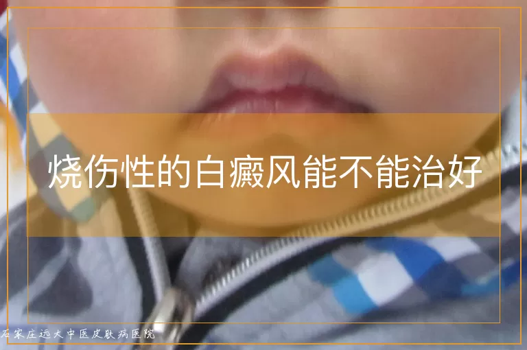 烧伤性的白癜风能不能治好