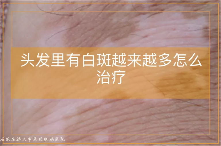 头发里有白斑越来越多怎么治疗