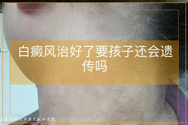 白癜风治好了要孩子还会遗传吗