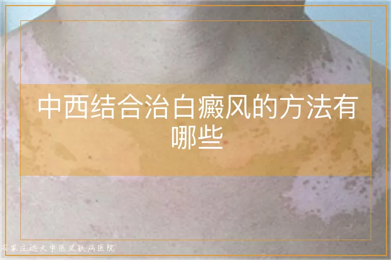 中西结合治白癜风的方法有哪些