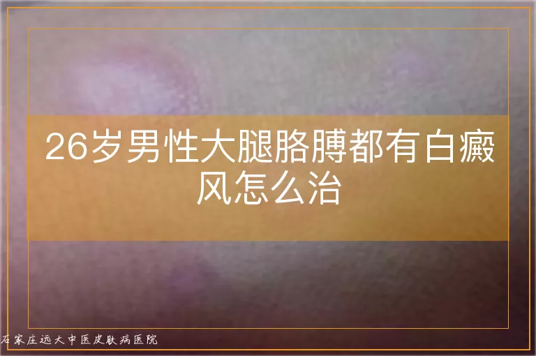26岁男性大腿胳膊都有白癜风怎么治