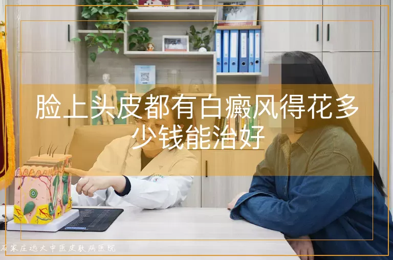 脸上头皮都有白癜风得花多少钱能治好