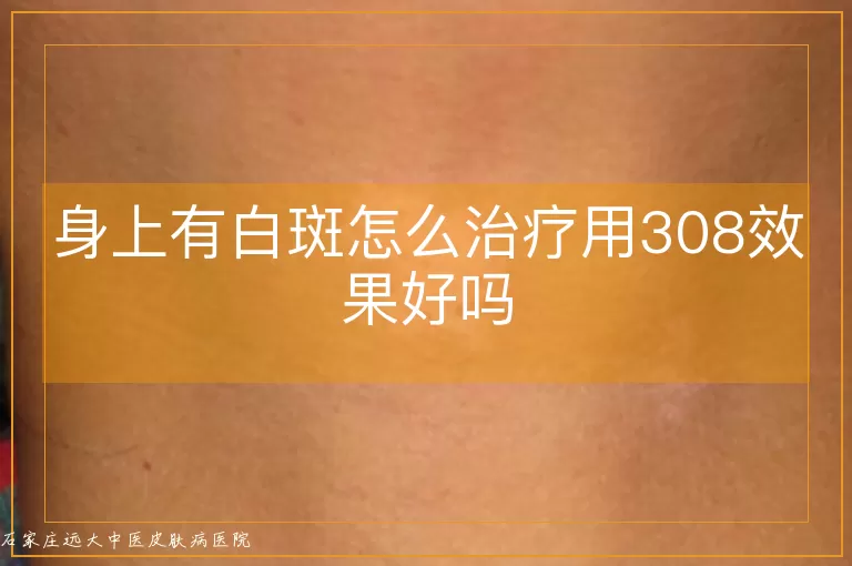 身上有白斑怎么治疗用308效果好吗