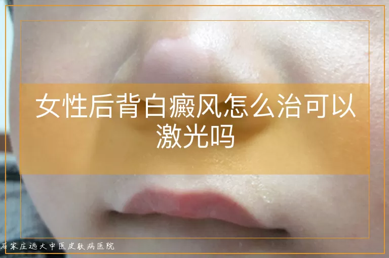 女性后背白癜风怎么治可以激光吗