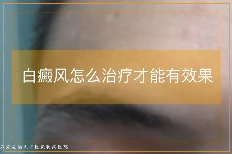 白癜风怎么治疗才能有效果