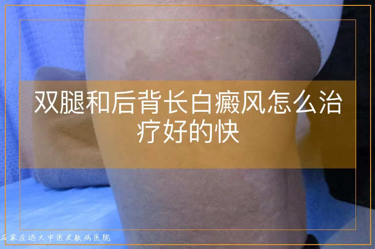 双腿和后背长白癜风怎么治疗好的快