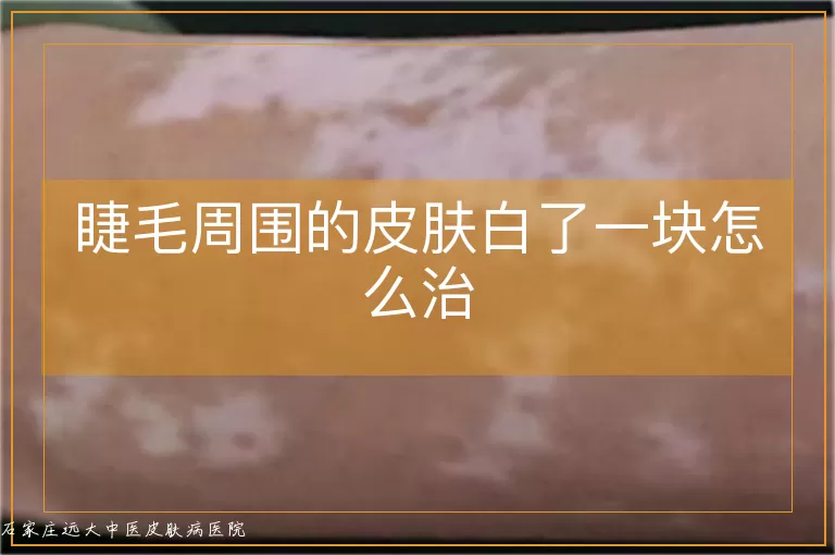睫毛周围的皮肤白了一块怎么治