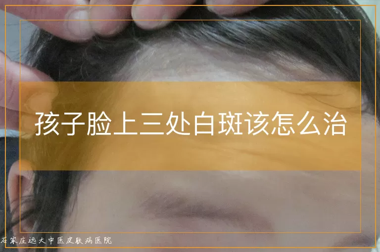 孩子脸上三处白斑该怎么治