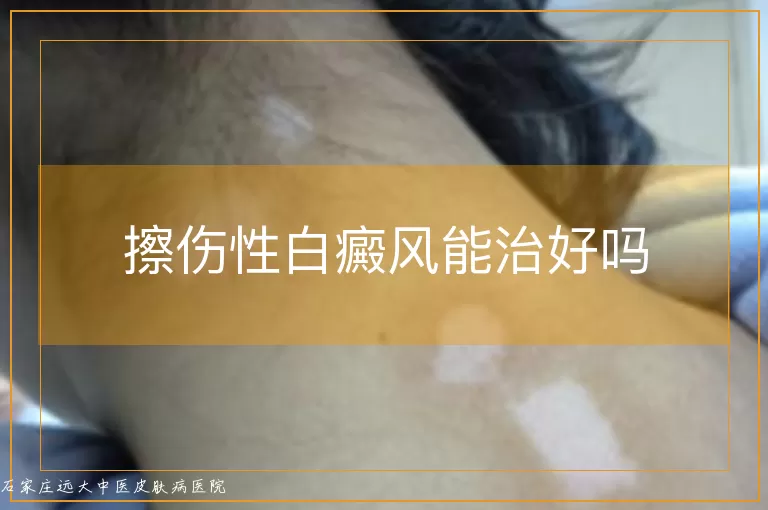 擦伤性白癜风能治好吗