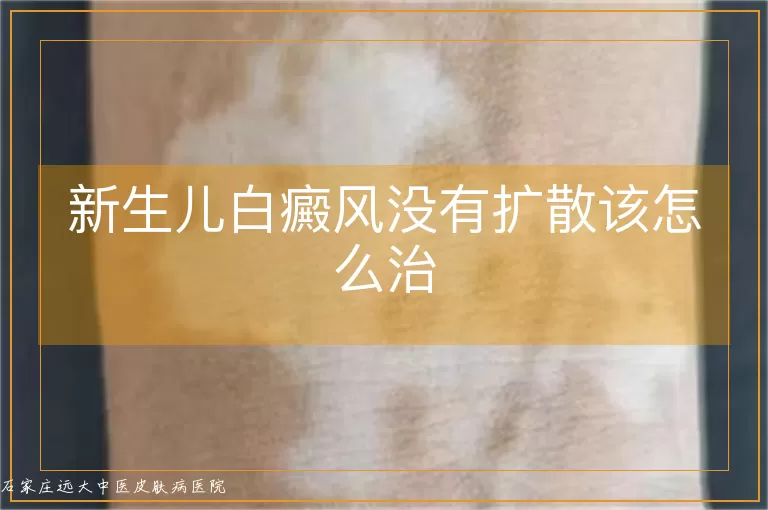 新生儿白癜风没有扩散该怎么治