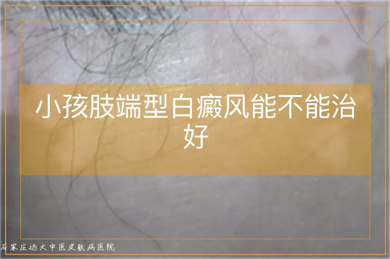 小孩肢端型白癜风能不能治好