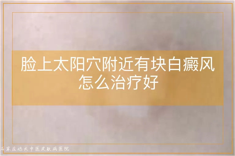 脸上太阳穴附近有块白癜风怎么治疗好