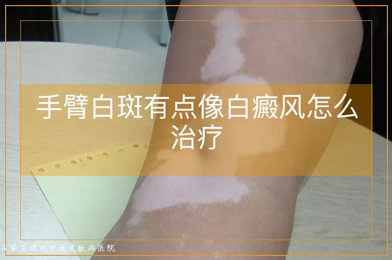 手臂白斑有点像白癜风怎么治疗