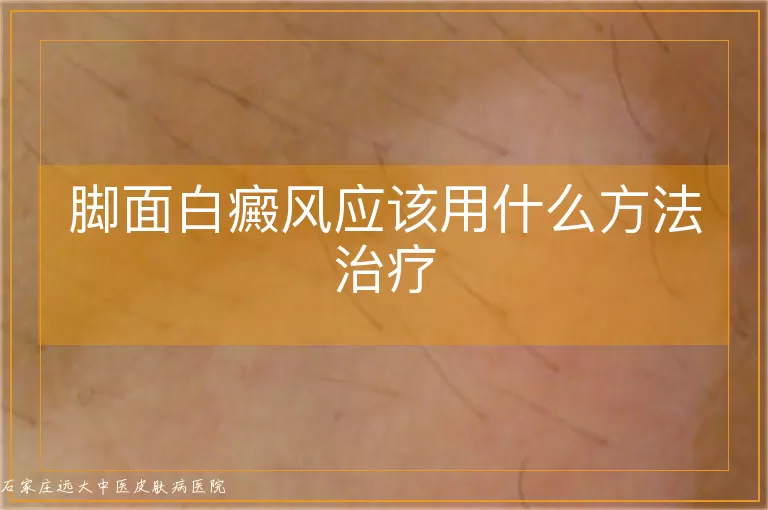 脚面白癜风应该用什么方法治疗