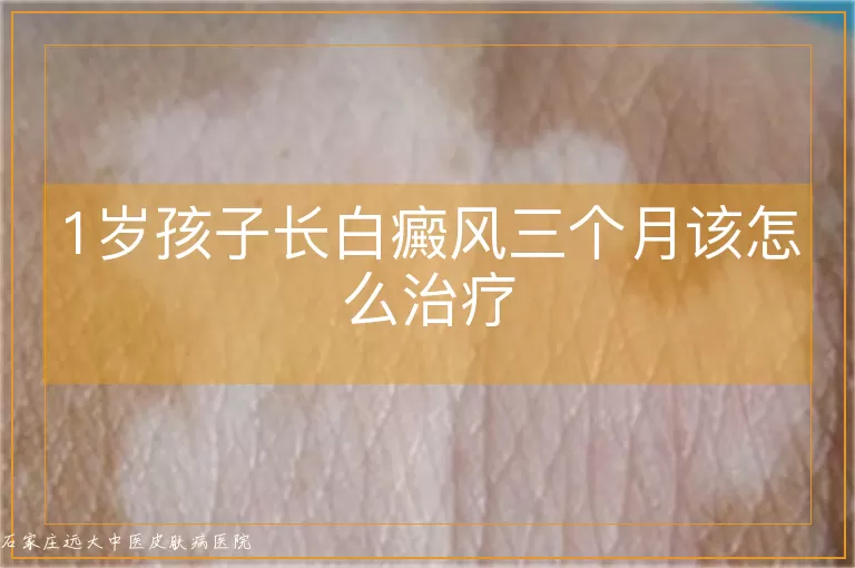 1岁孩子长白癜风三个月该怎么治疗