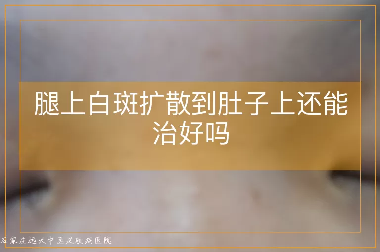 腿上白斑扩散到肚子上还能治好吗