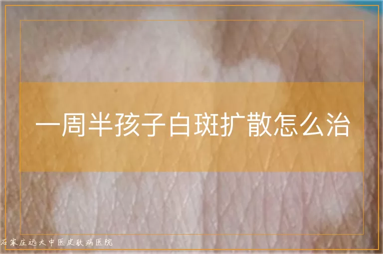 一周半孩子白斑扩散怎么治