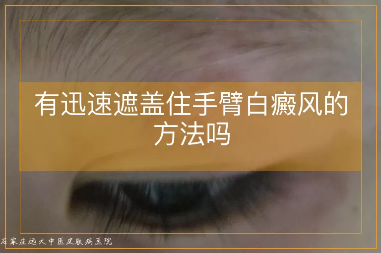 有迅速遮盖住手臂白癜风的方法吗