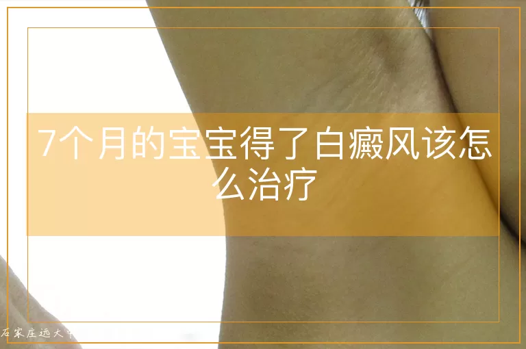 7个月的宝宝得了白癜风该怎么治疗