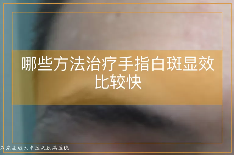 哪些方法治疗手指白斑显效比较快