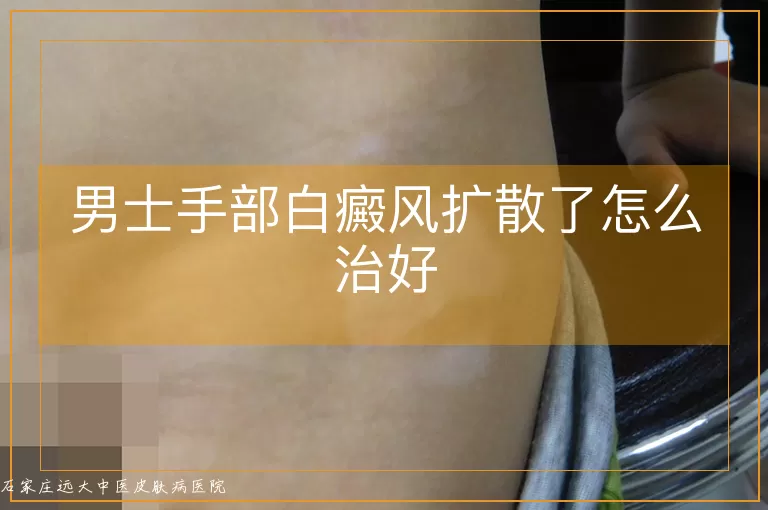 男士手部白癜风扩散了怎么治好