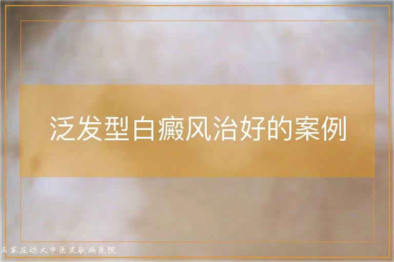泛发型白癜风治好的案例
