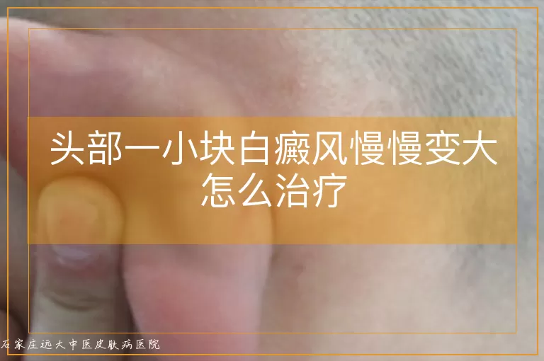 头部一小块白癜风慢慢变大怎么治疗